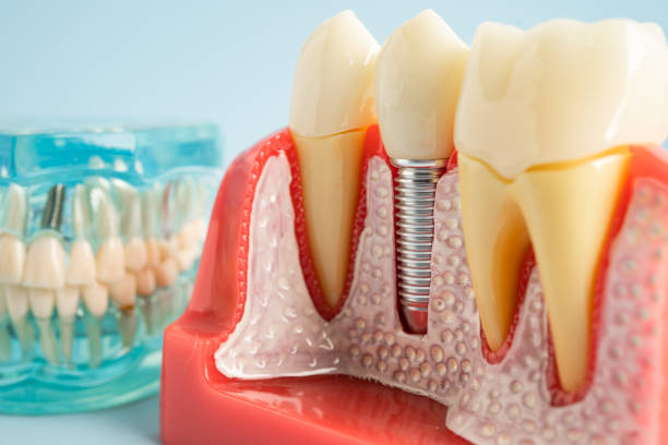 Best Root Canal Treatment  in Aventura, FL